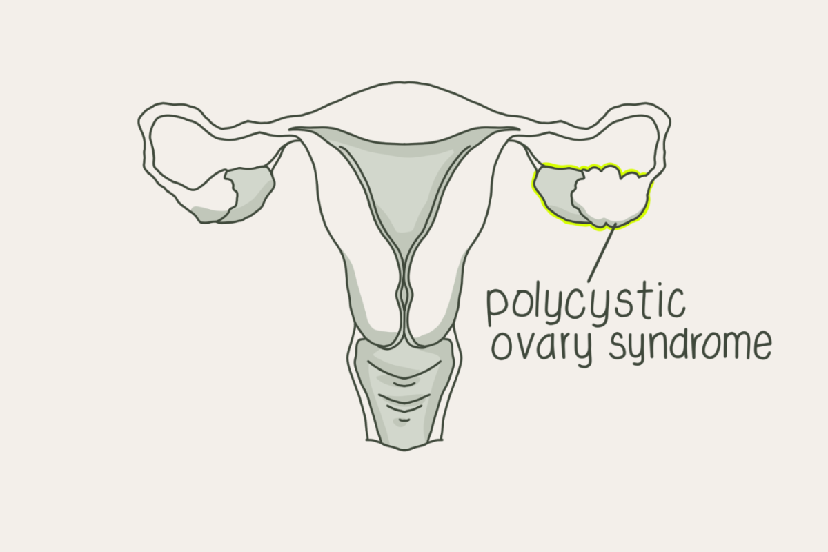 What Is PCOS? Signs, Causes, and How to Manage Polycystic Ovary Syndrome